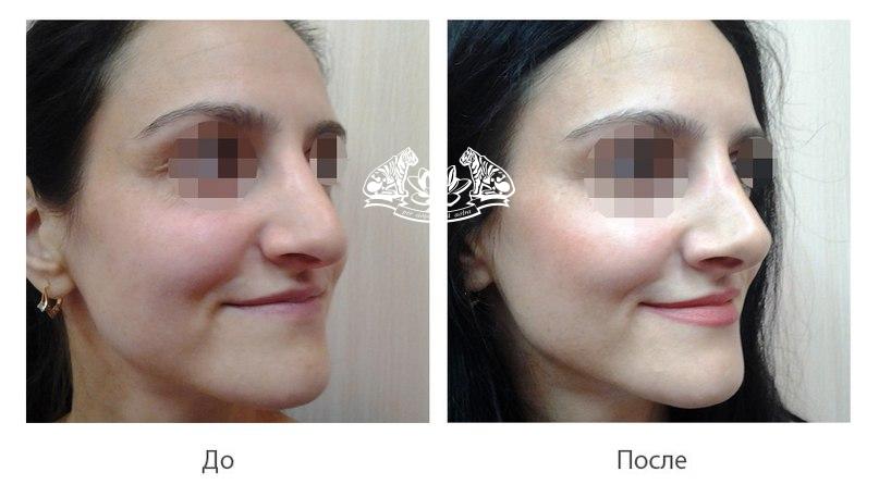 Лазерное лечение вросшего ногтя до и после Лазерное лечение вросшего ногтя до и после