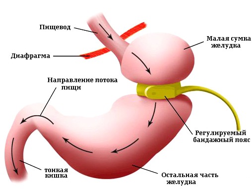 Операция чтобы уменьшить желудок какие желчегонные препараты можно принимать после удаления желчного пузыря